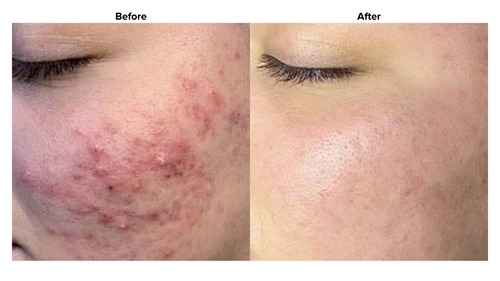 biorepeel peeling na trądzik efekty przed i po 2