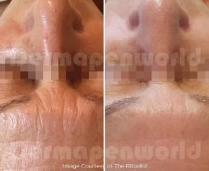 Mezoterapia mikroigłowa Dermapen 4 — efekt przed i po zabiegu, pacjent 2