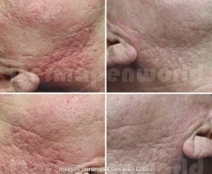 Mezoterapia mikroigłowa Dermapen 4 — efekt przed i po zabiegu, pacjent 7