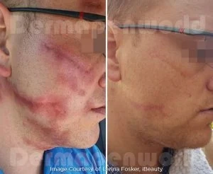 Mezoterapia mikroigłowa Dermapen 4 — efekt przed i po zabiegu, pacjent 4