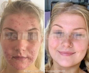 Mezoterapia mikroigłowa Dermapen 4 — efekt przed i po zabiegu, pacjent 3