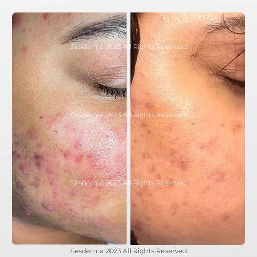 salipeel peeling na trądzik efekty przed i po