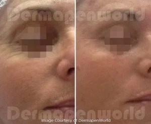 Mezoterapia mikroigłowa Dermapen 4 — efekt przed i po zabiegu, pacjent 1