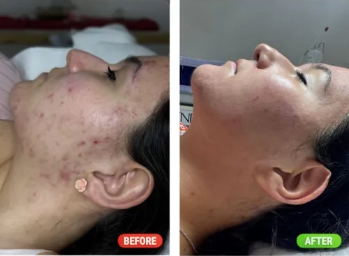 peeling mediderma na trądzik efekty przed i po