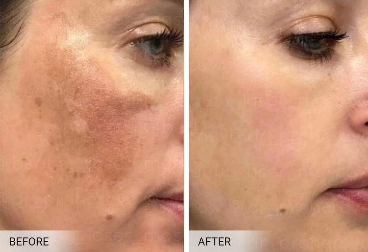 biorepeel peeling na przebarwienia efekty przed i po